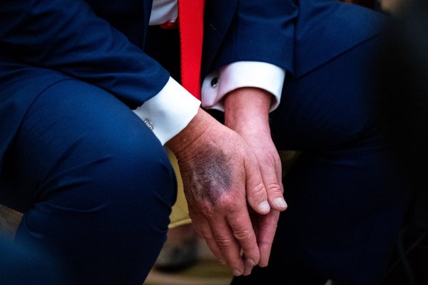 Moretones en las manos, hinchazón en piernas y ratos prolongados con los ojos cerrados: la salud de Trump reabre debate ante próximo examen médico
